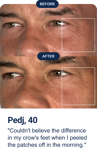 Pedj, 40: "Couldn't believe the difference in my crow's feet when I peeled the patches off in the morning."