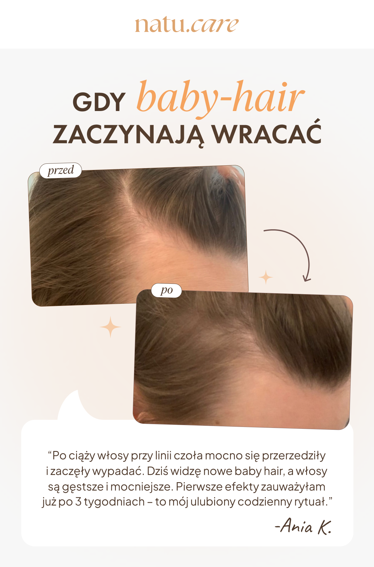 Efekty kuracji kolagenem Natu.Care – mniej wypadających włosów, większa gęstość i baby hair.