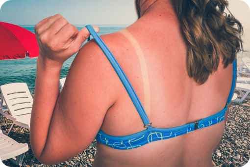 Woman with a sunburn