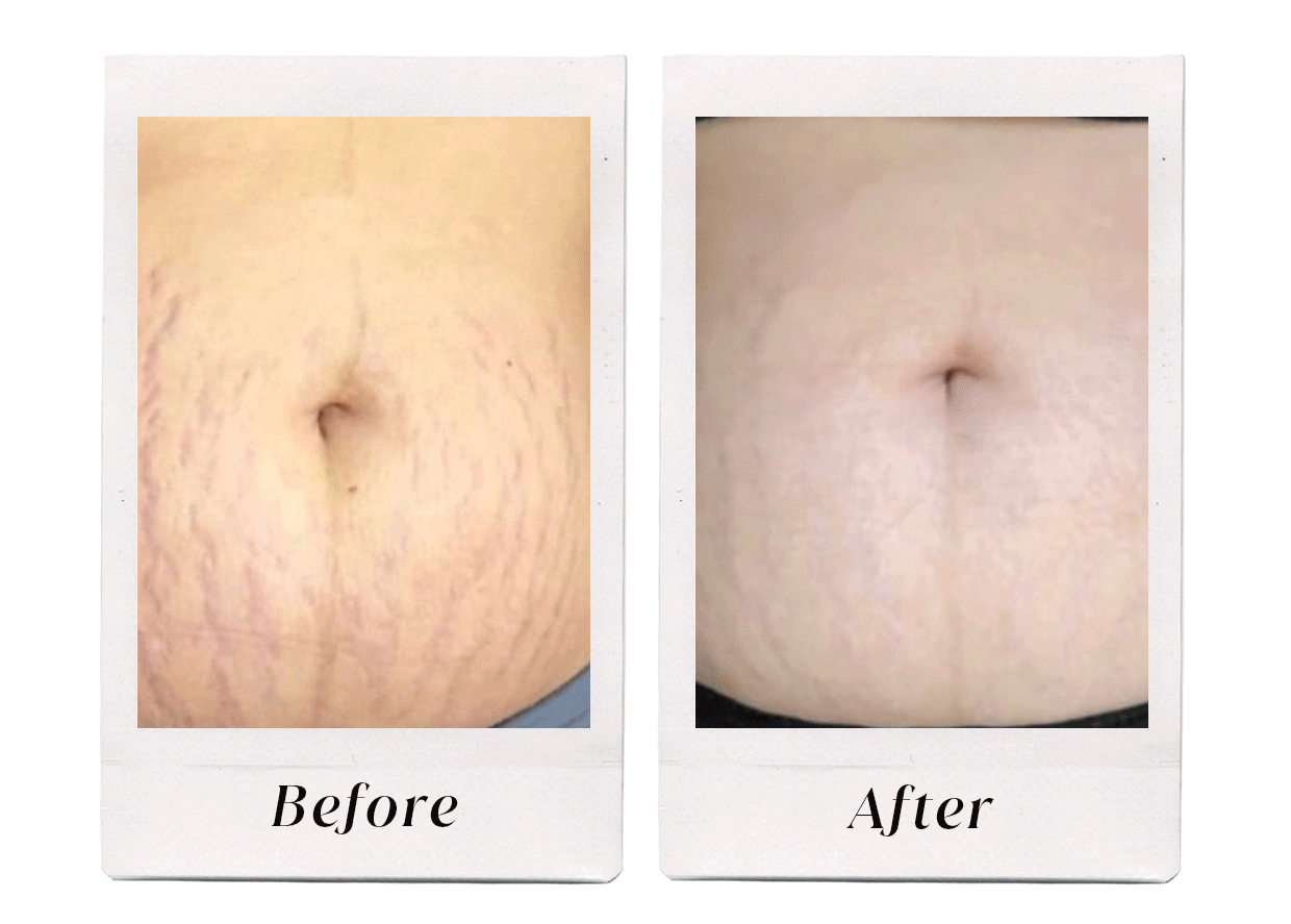 Fade stretch marks in 2 simple steps Bangn Body