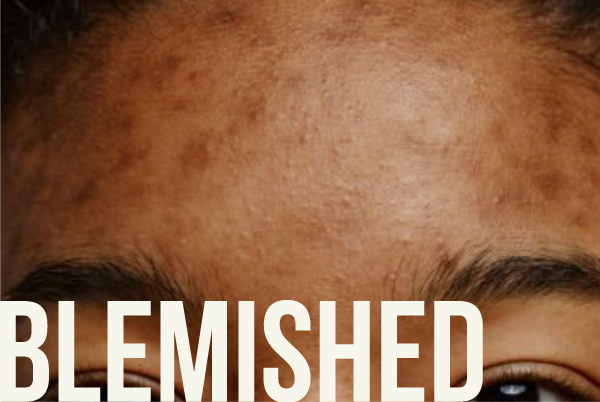 Blemished Skin