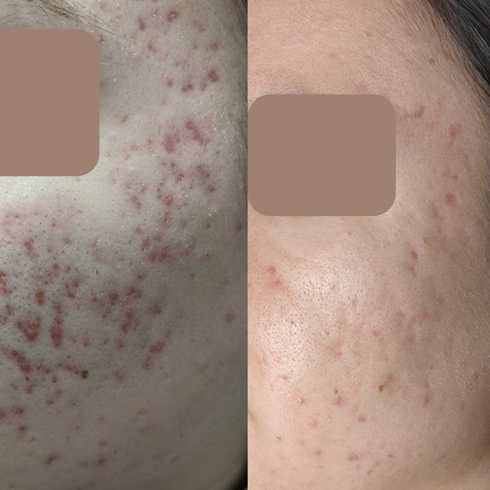 Acne: The Bane of Teenage Existence