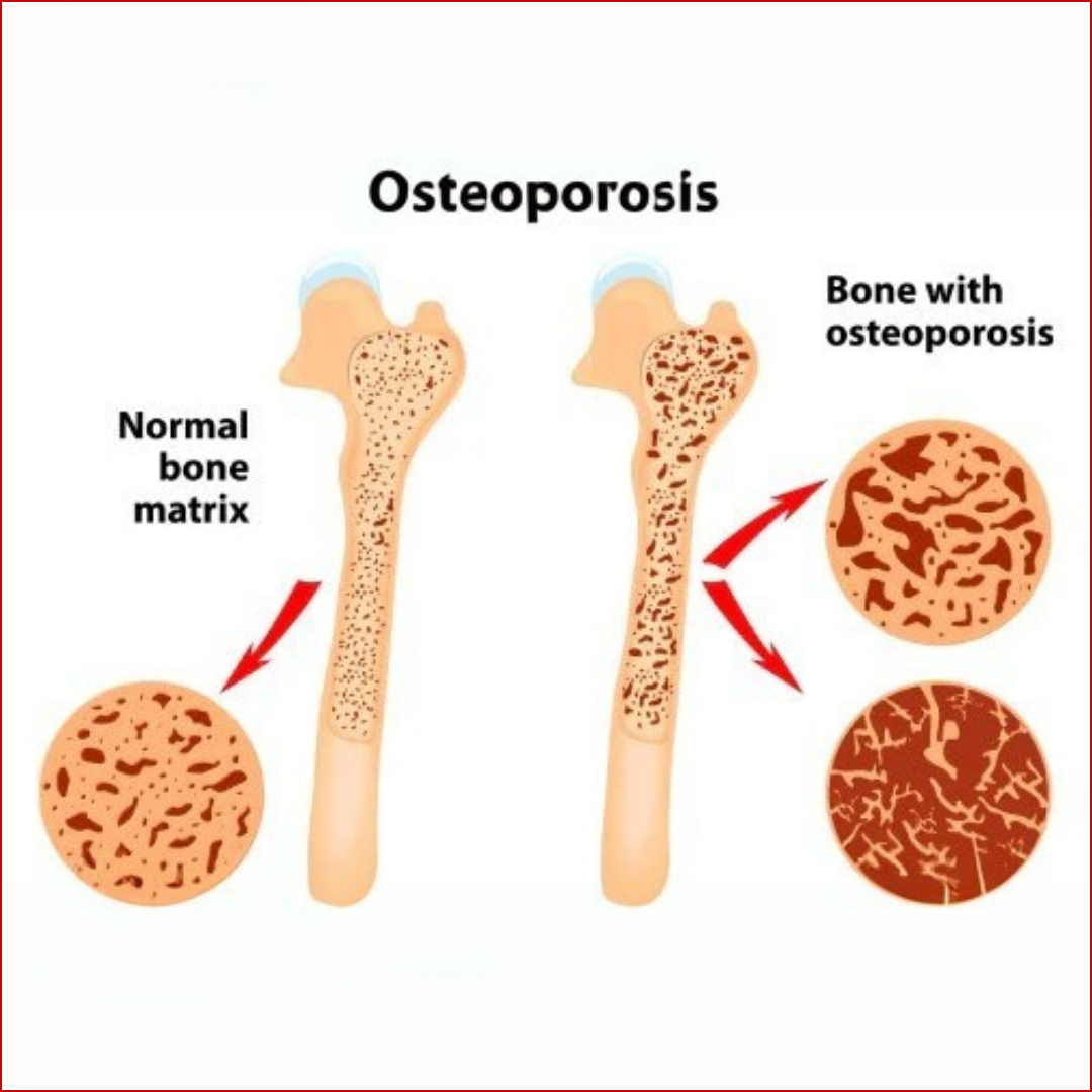 Osteoporosis and TCM