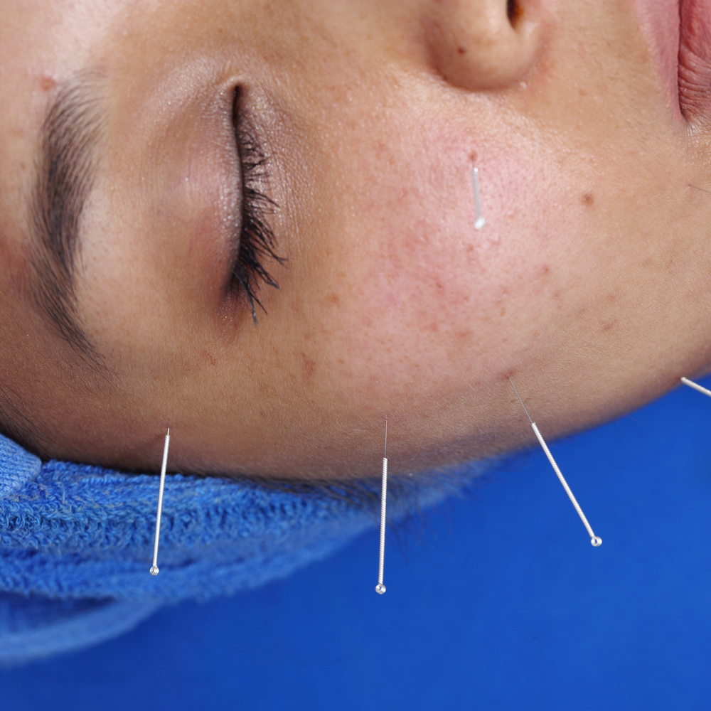 TCM Approaches for Bell's Palsy