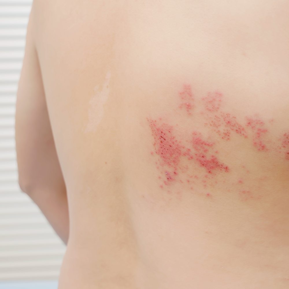 TCM for Shingles / Herpes Zoster Virus