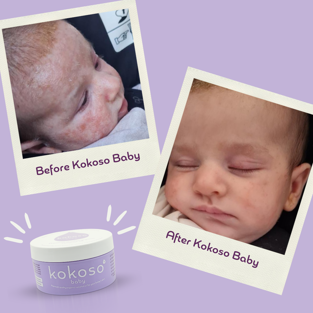 Skin transformations 😍 Kokoso Baby Skincare