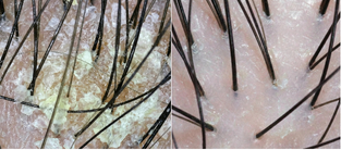 Scalp dermatoscopy: heavy flaking and buildup before vs clear healthy scalp after 3 months with AWARE