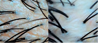 Scalp dermatoscopy: buildup and discoloration before vs clean, clear scalp after one wash with AWARE