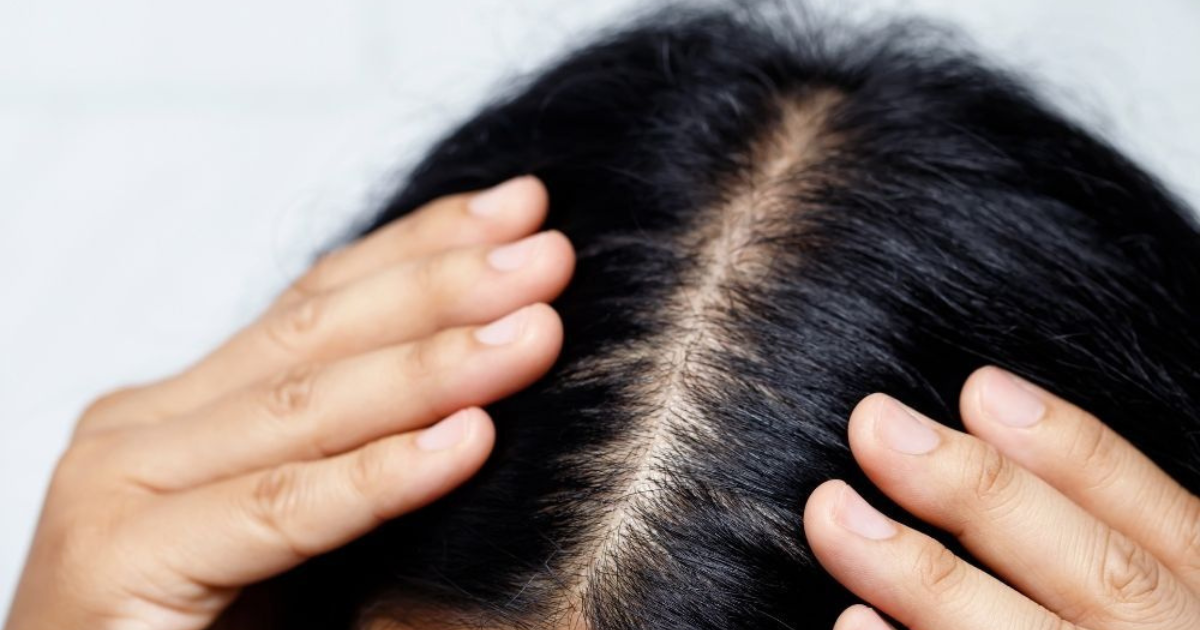 Healthy scalp with clean center part