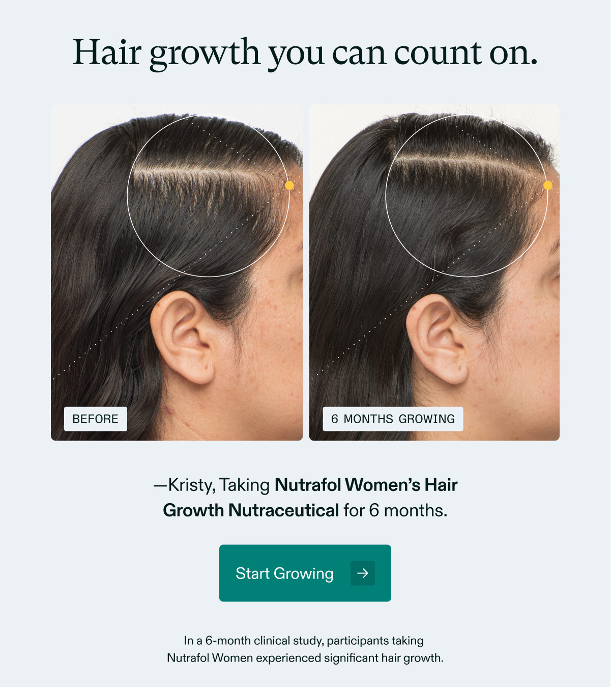 Hair growth you can count on. —Kristy, Taking Nutrafol Women’s Hair Growth Nutraceutical for 6 months.  Start Growing →  In a 6-month clinical study, participants taking Nutrafol Women experienced significant hair growth.