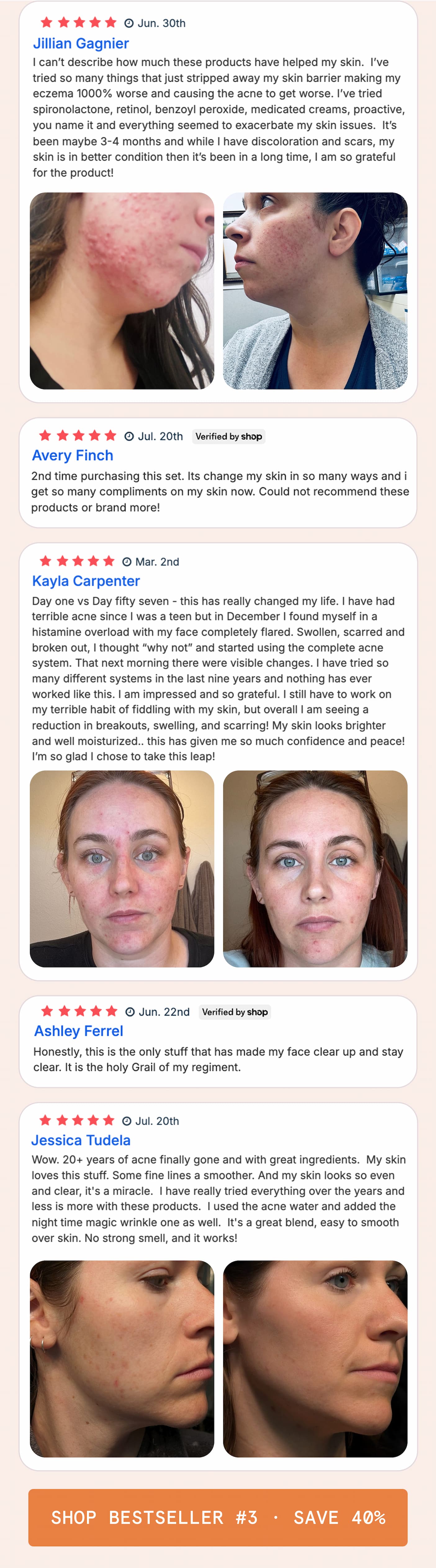 The Complete Acne System for Women