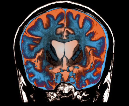 MRI image of a brain with Huntington's Disease
