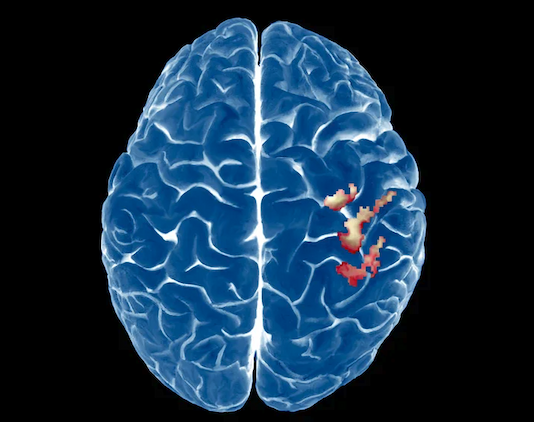 A 3-D fMRI brain scan with a red/brown area highlighting left hand control brain activity in the right cerebral hemisphere