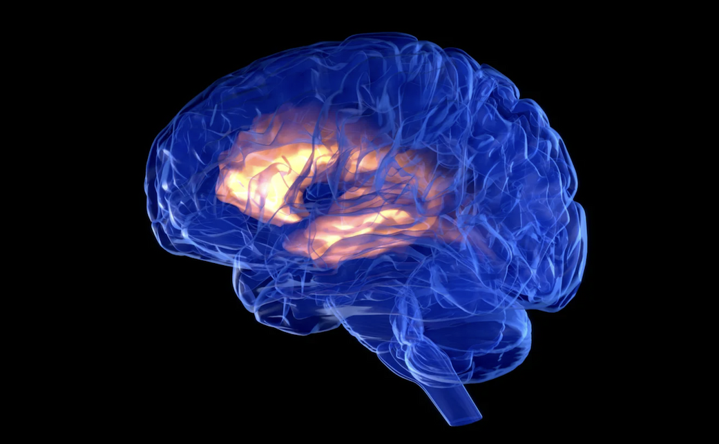 An artist's depiction of a brain with an implant inside