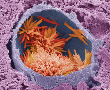 Spiky orange cells cluster within a broken-open cell