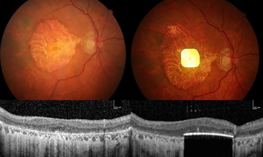 Composite image of scans of the chip in a patient's eye