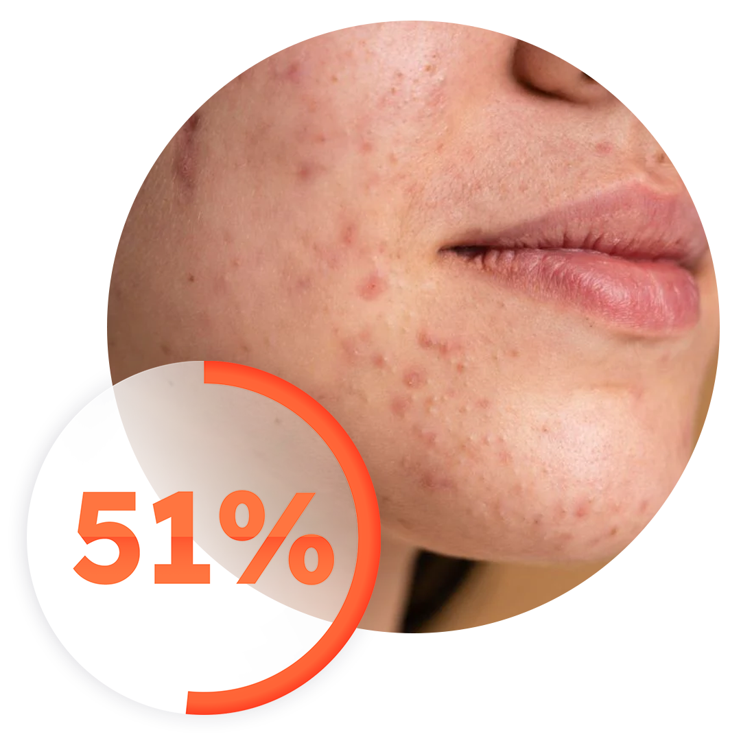 51% say a breakout can affect their mood for some or all of the day