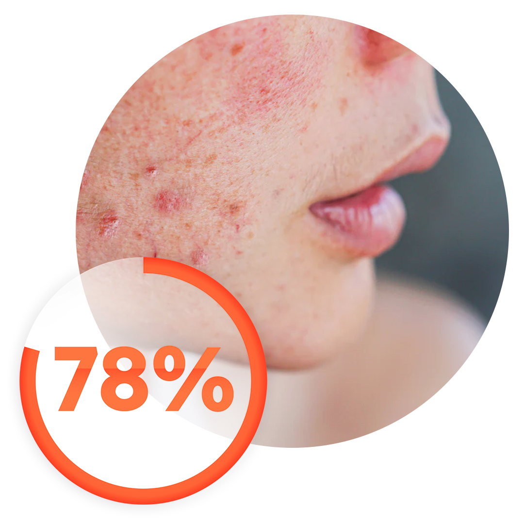 78% of Gen-Z acne sufferers are confused about the root cause of their acne