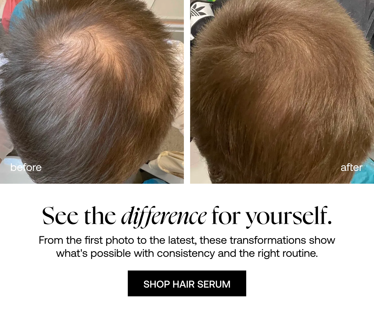 Hair Growth Serum before and after 