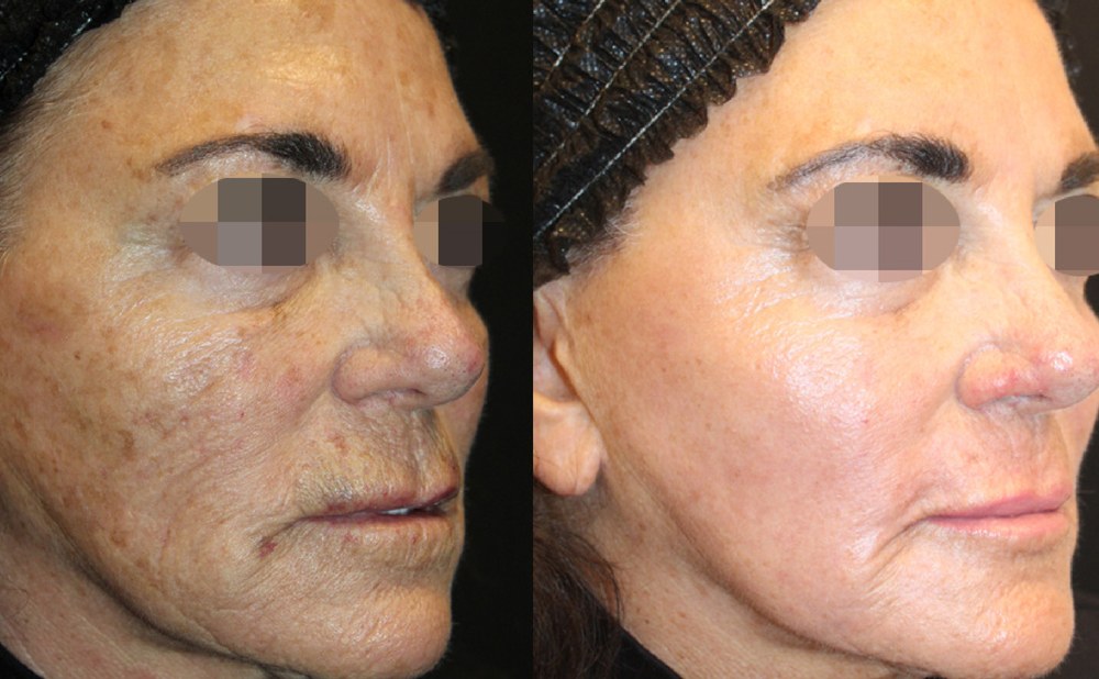 Alma Hybrid before and after: sun damage and wrinkles