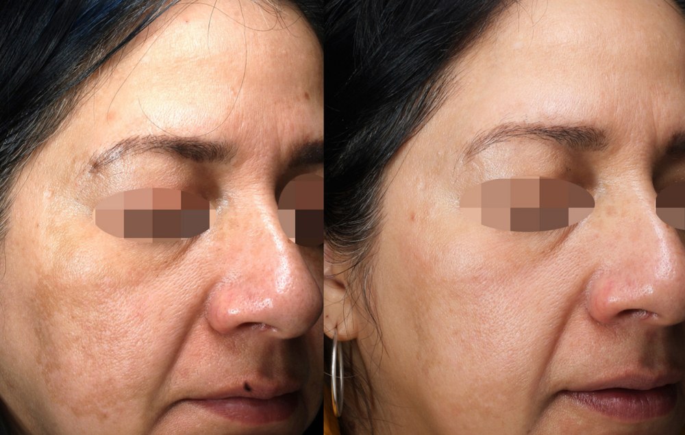 Alma Hybrid before and after: pigmentation and tone