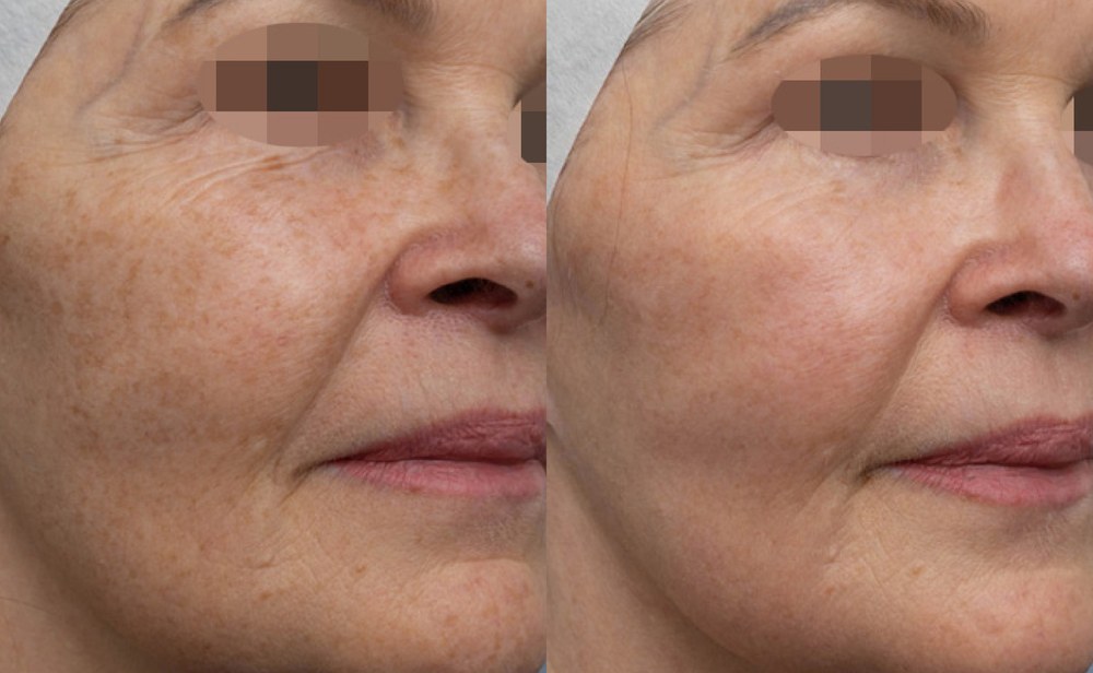 Alma Hybrid before and after: cheek texture and fine lines