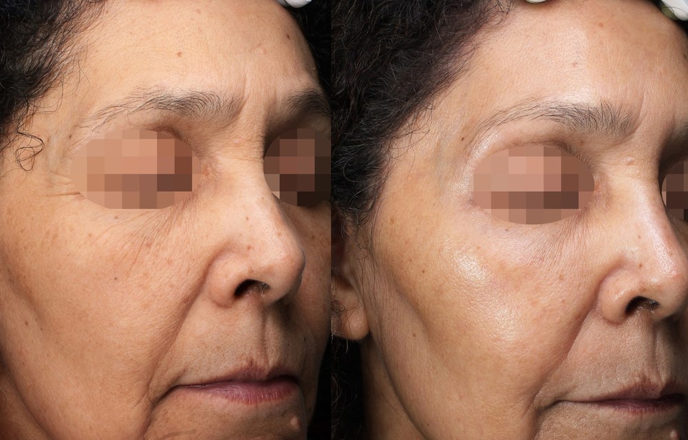 Alma Hybrid before and after: pigmentation and wrinkles