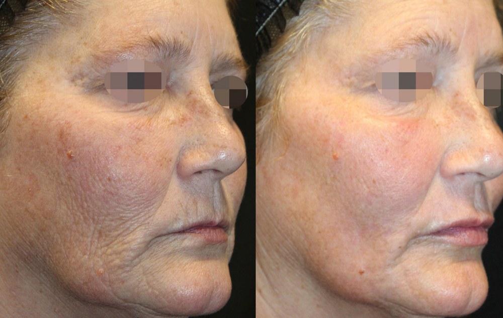 Alma Hybrid before and after: sun damage and texture