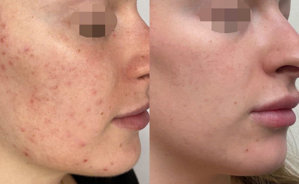 Alma Hybrid before and after: acne and acne scarring