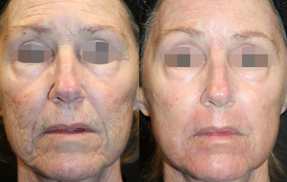 Alma Hybrid before and after: deep wrinkles and skin renewal