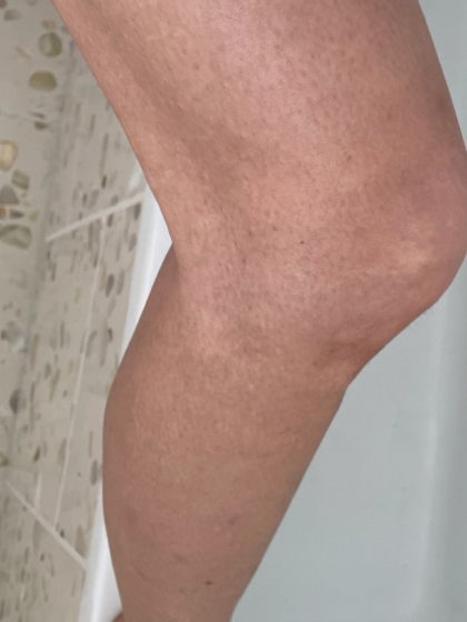 Keratosis pilaris