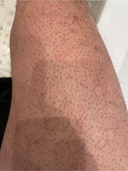 Upper Leg