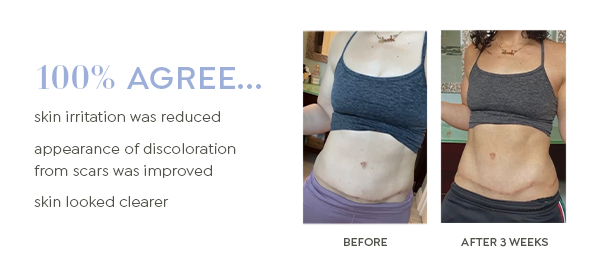 Scar Gel Treatment