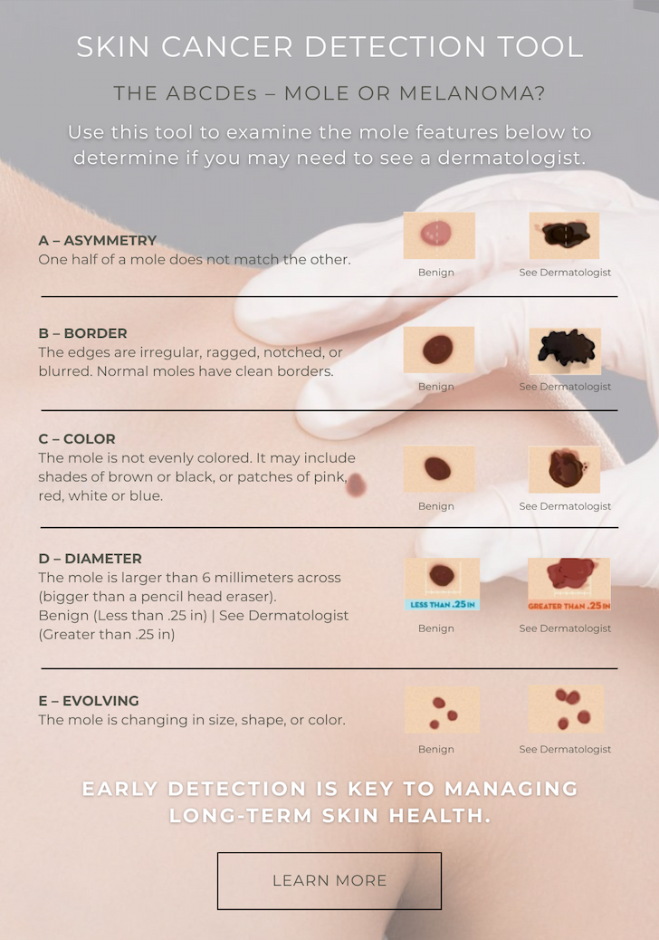 Spots & Discoloration: How to Know When to Get Checked by A Dermatologist