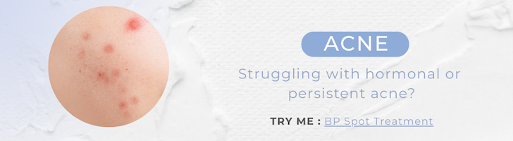 5% Benzoyl Peroxide Acne Spot Treatment