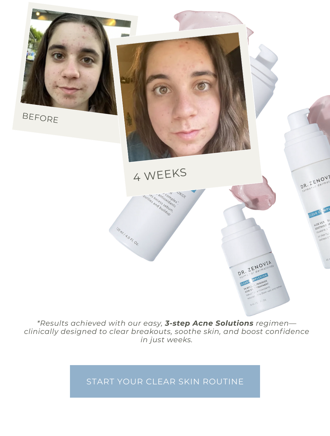 Acne Solutions System