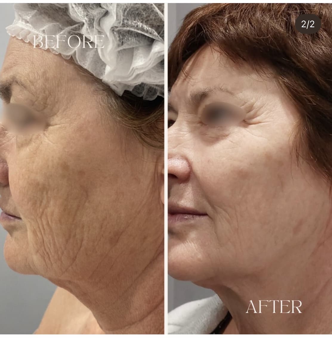 Winter Mini Skin Makeover before and after